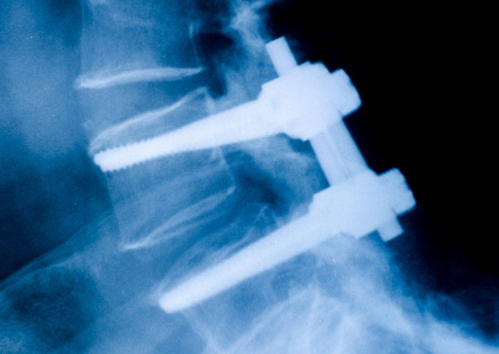 Spinal Implant Testing